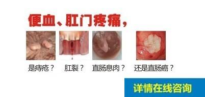 肛门疼痛便血？在线咨询博仕中医医生